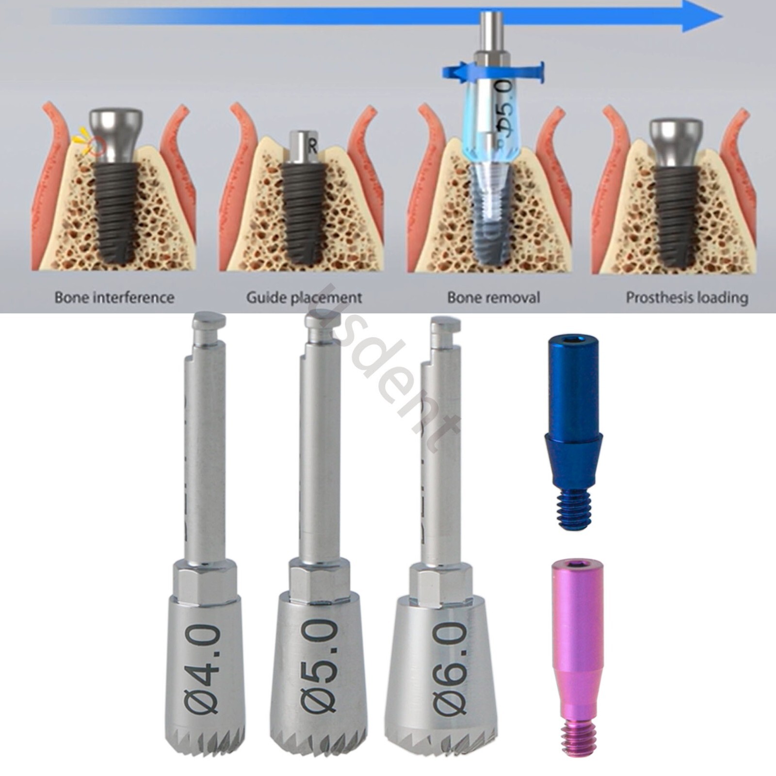 Implant Bone Profiler Guide Screw Surgical Instrument fit OSSTEM Hiossen 4/5/6mm