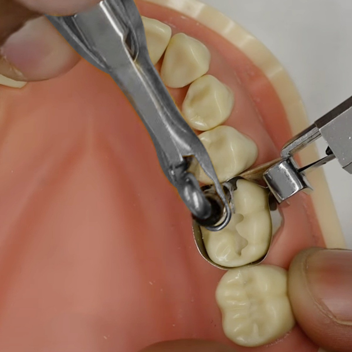 Waldent Amalgam Carrier Double Ended 2.5 x 2.0mm (12/105)