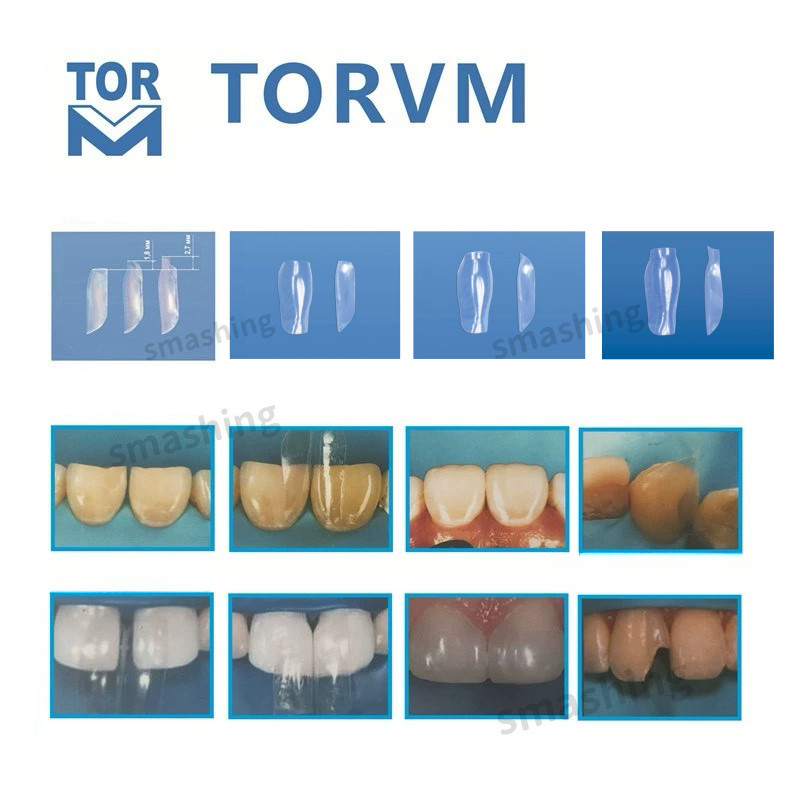 Dental Clear Matrix TOR VM Anterior Matrices BT Fits Bioclear TOP BM USA STOCK