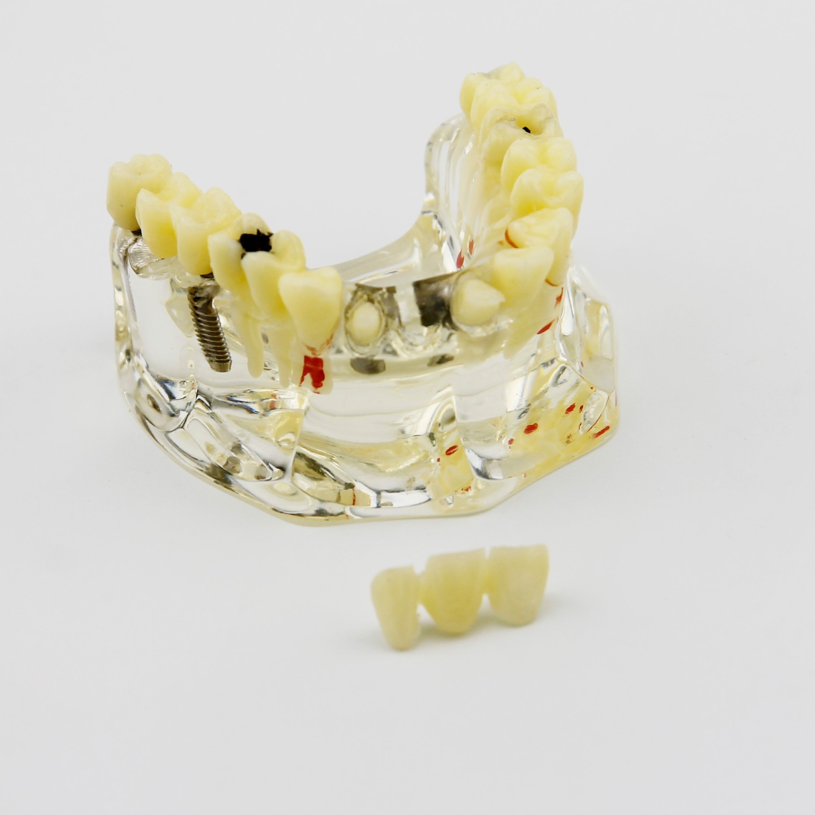 Dental Upper Jaw Implant Model with Bridge and Caries -I 2006