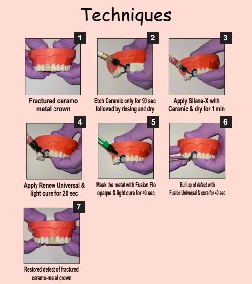 Dental A.C.E Ceramic Repair Kit for intraoral repairs of ceramic and composite