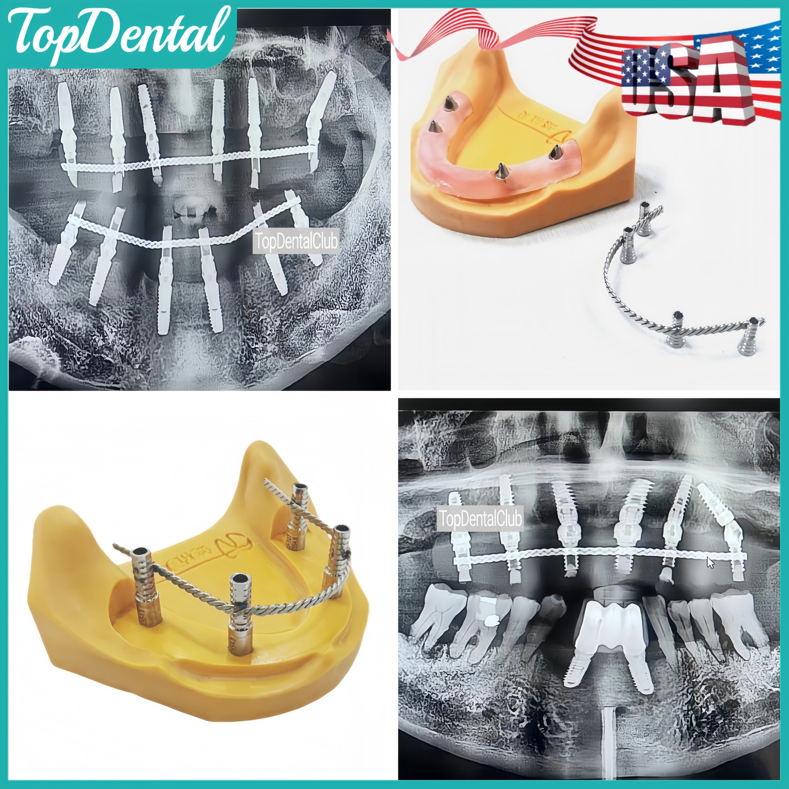 USA Dental Connector Stainless Tianium Strengthener Wire Overdenture MU Implant