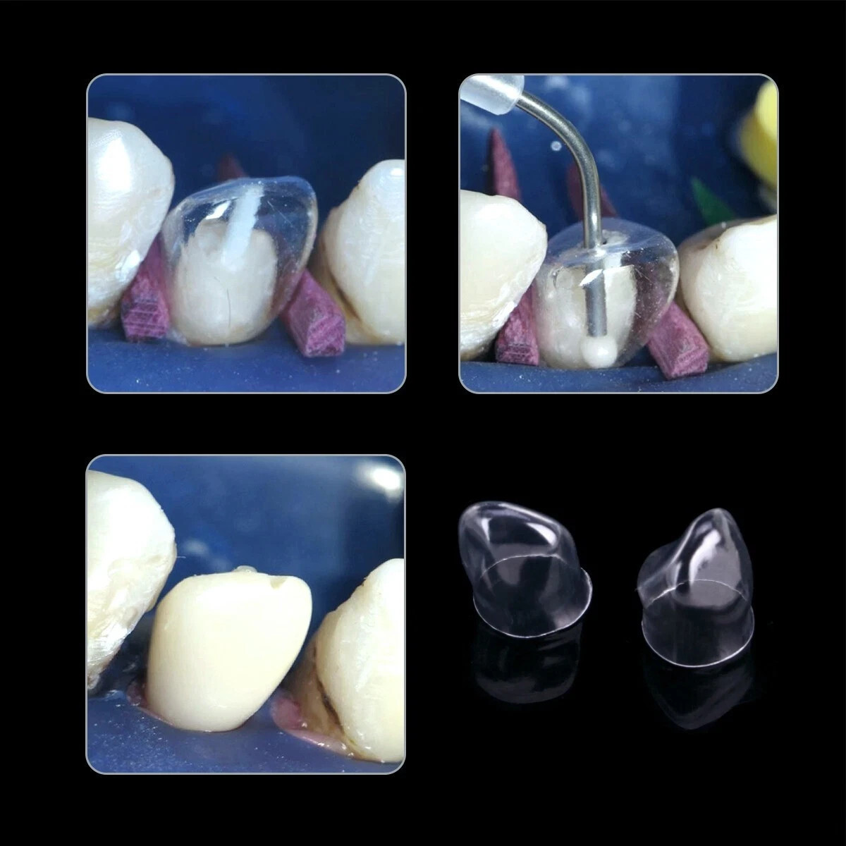 Dental 64Pcs Adult Resin Temporary Transparent Crowns TOR VM 1.910/1.911 Opt Kit