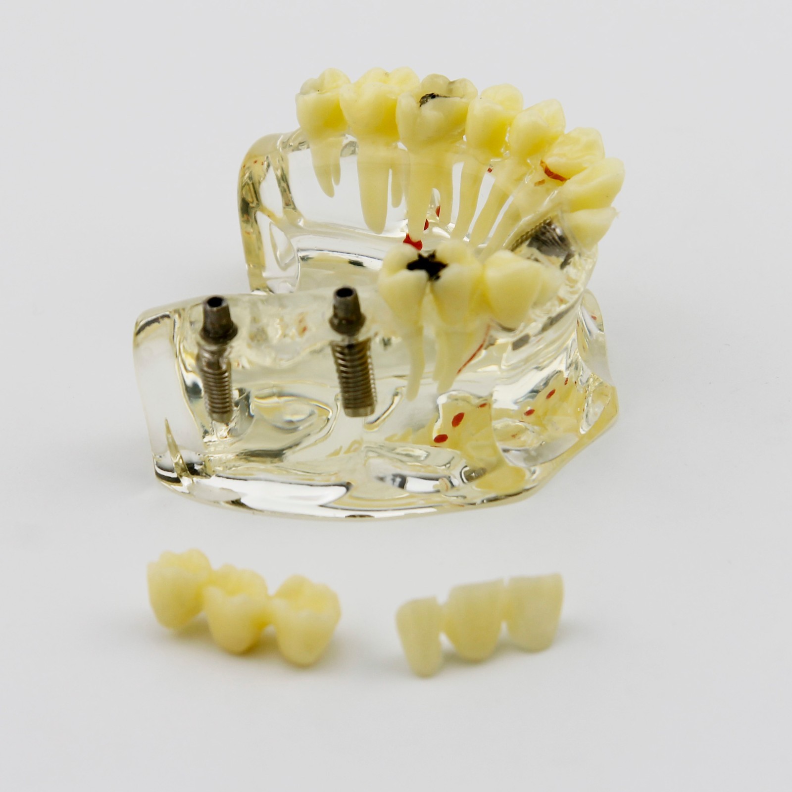 Dental Upper Jaw Implant Model with Bridge and Caries -I 2006