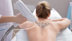 A medical professional performing laser tattoo removal on a patient's back, targeting a floral tattoo design with advanced laser equipment for effective treatment.