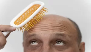 Hair Transplant