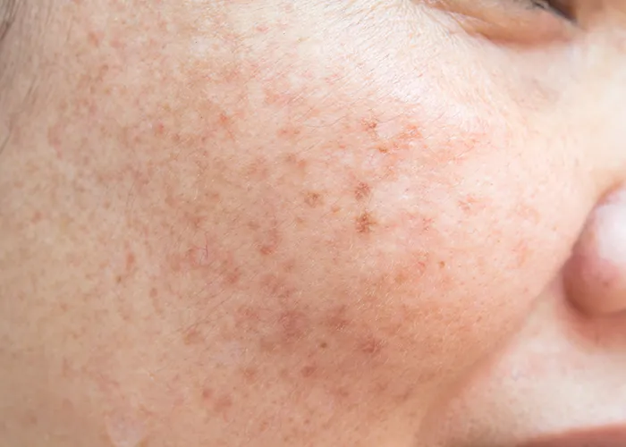 pigmentations and melasma