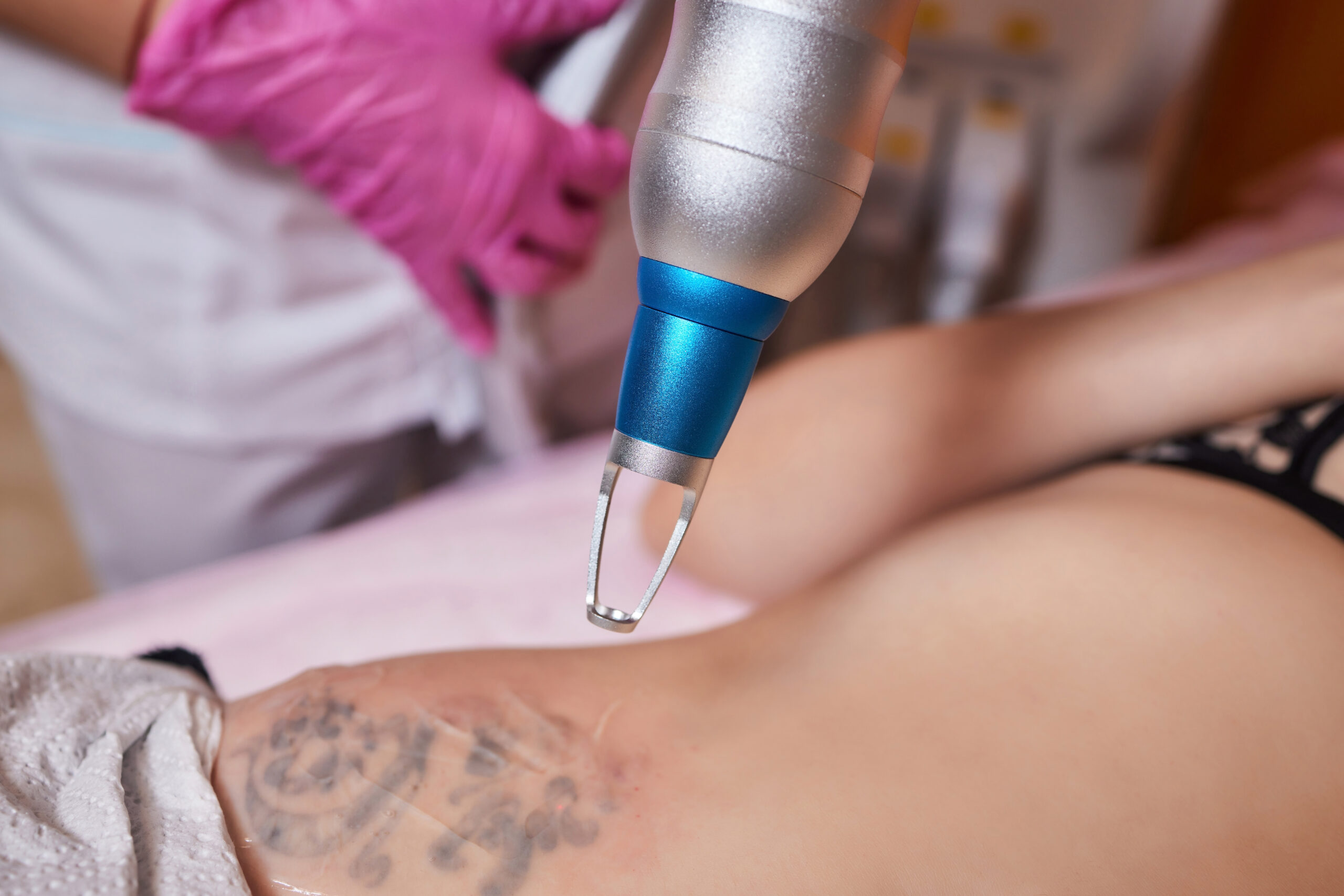 Young woman undergoing laser tattoo removal procedure in salon, closeup