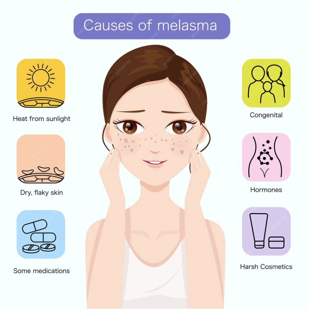 An illustrated infographic of a worried woman with melasma, showing dark patches on her cheeks. Around her, six icons represent the causes of melasma, including heat from sunlight, dry flaky skin, certain medications, congenital factors, hormonal changes, and harsh cosmetics. The title reads 'Causes of Melasma' in a purple banner at the top.