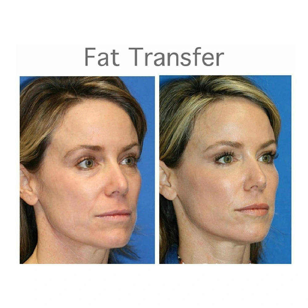 finesse before after mesolipo 1