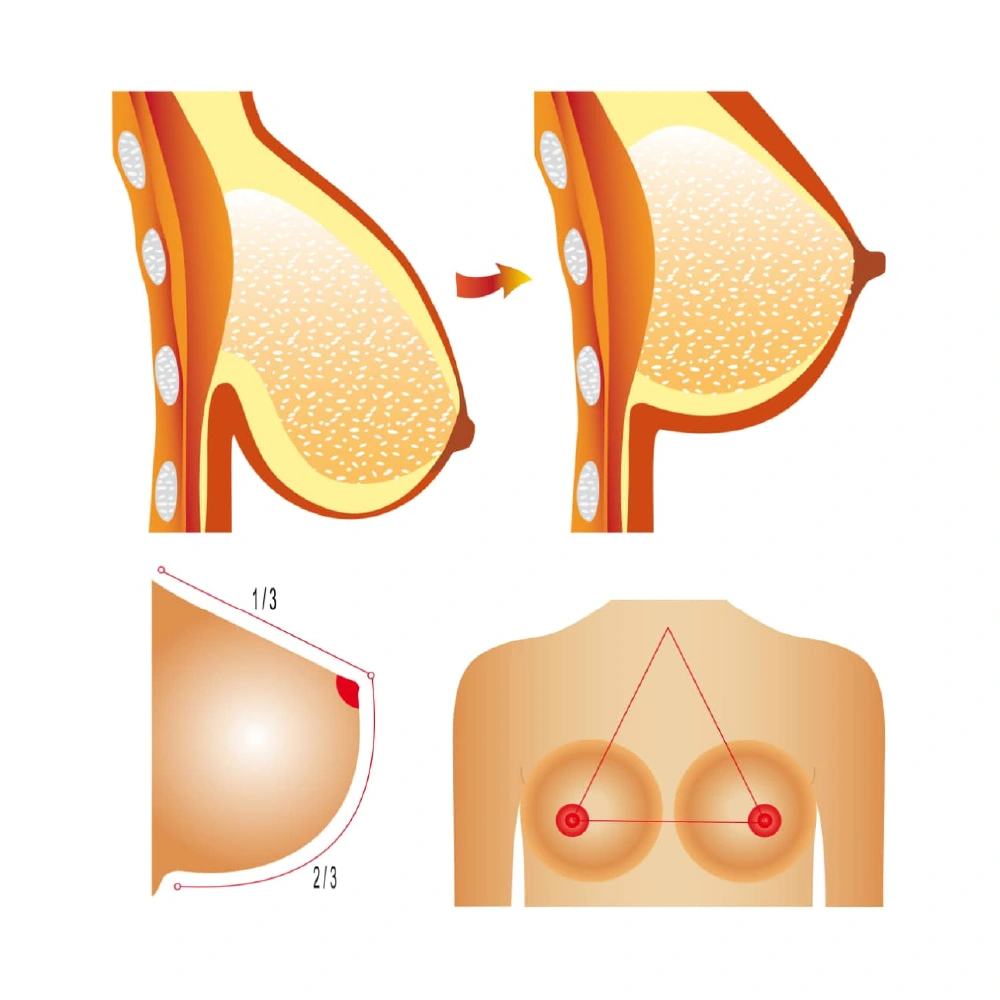 finesse before after mesolipo 10