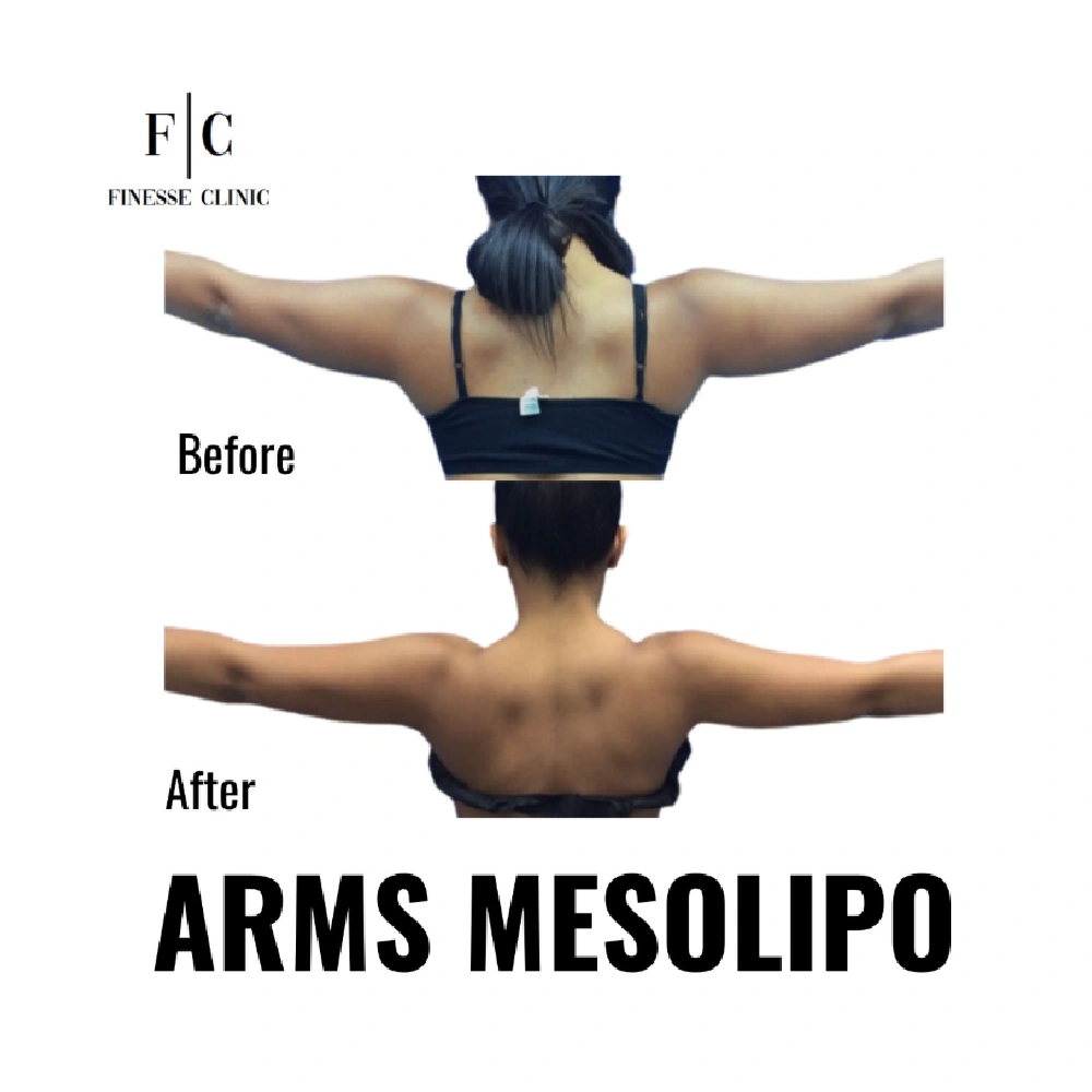 finesse before after mesolipo 2