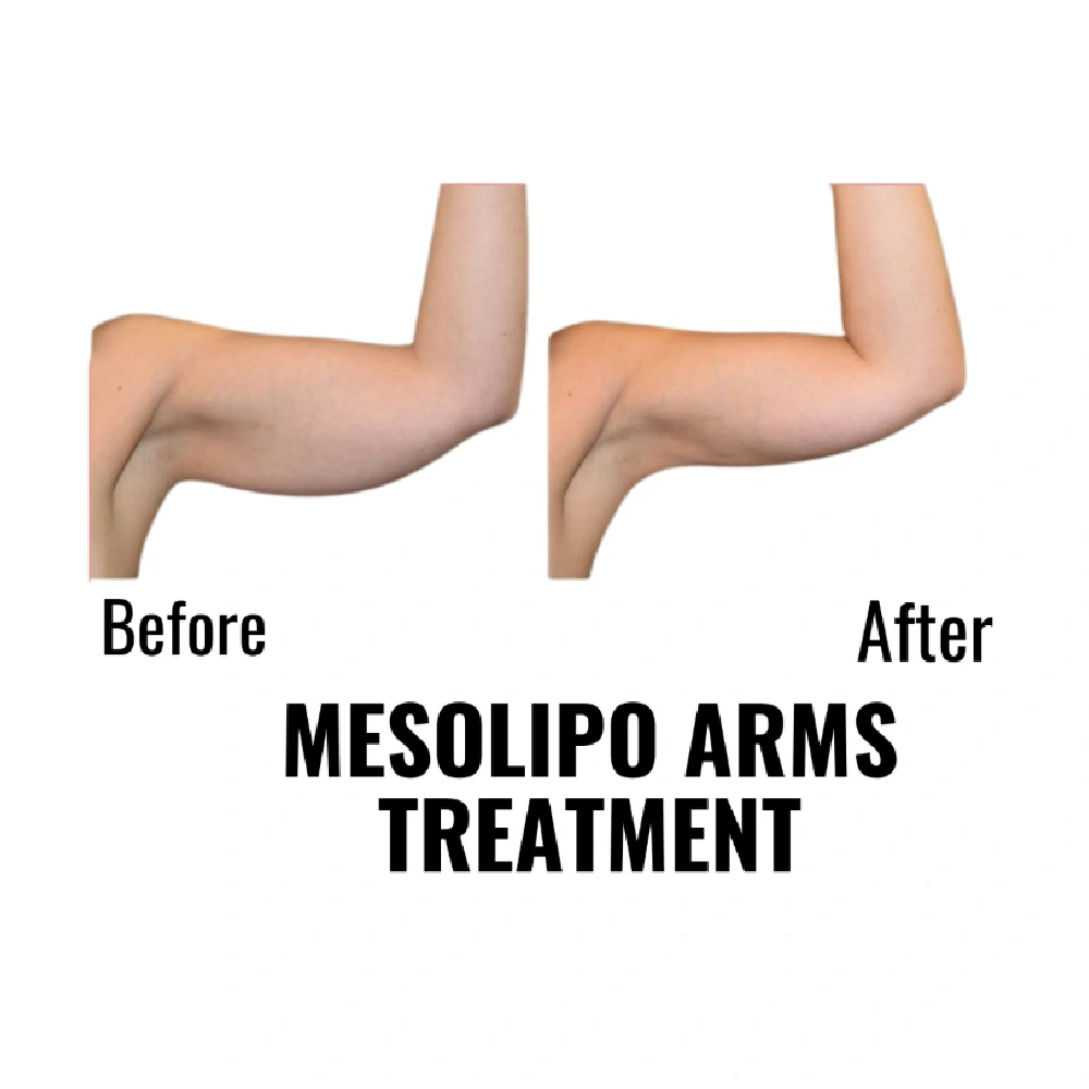 finesse before after mesolipo 3