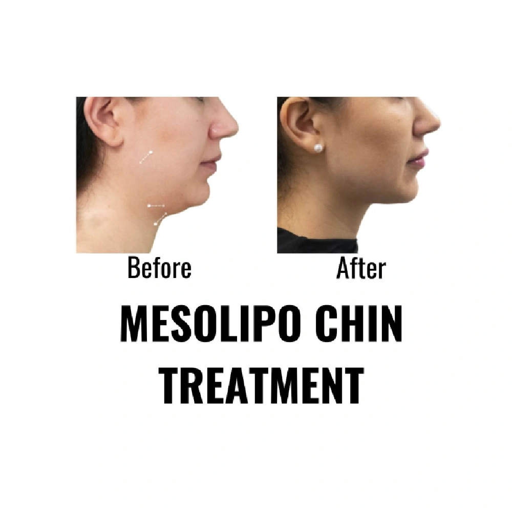 finesse before after mesolipo 7