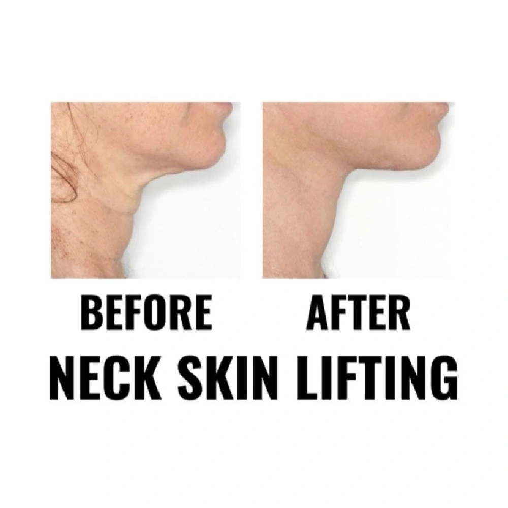 finesse before after mesolipo 8