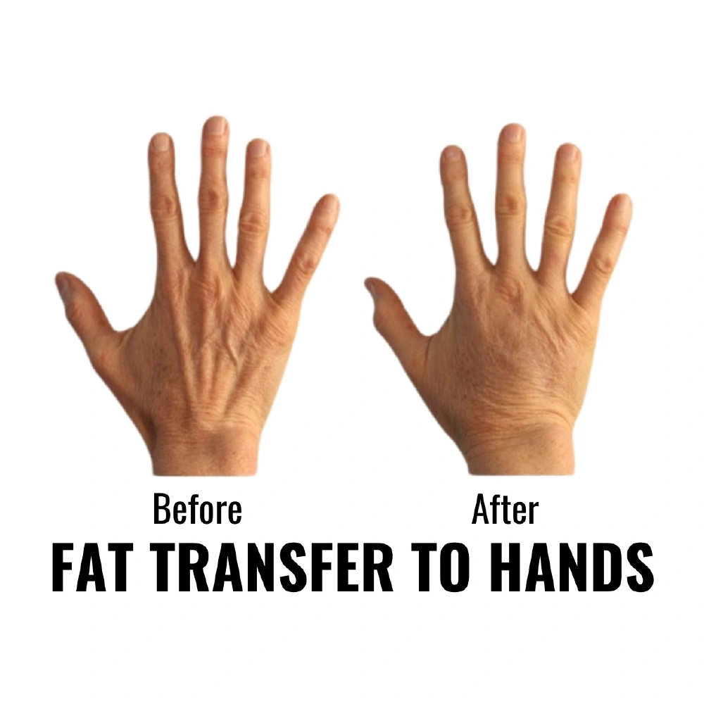 finesse before after mesolipo 9