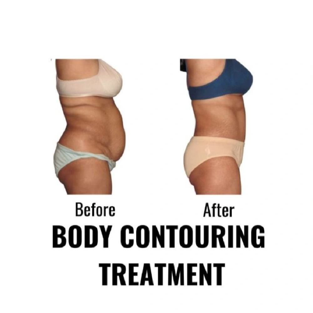 finesse mesolipo before after 1