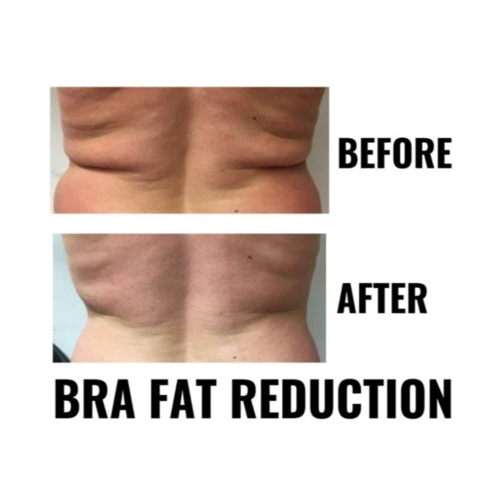 finesse mesolipo before after 2