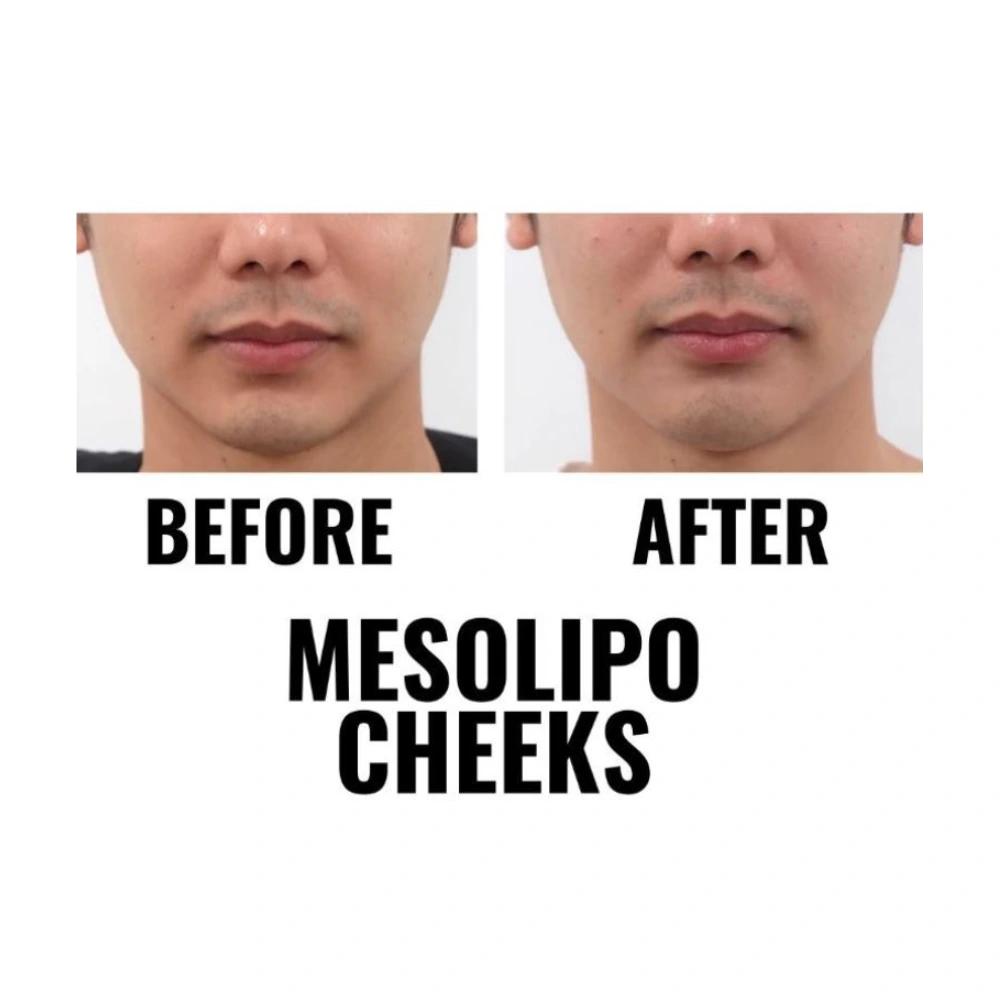 finesse mesolipo before after 3
