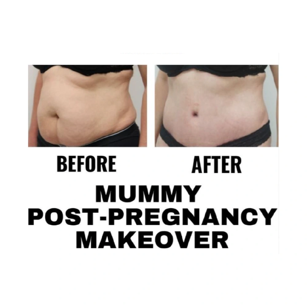 finesse mesolipo before after 4