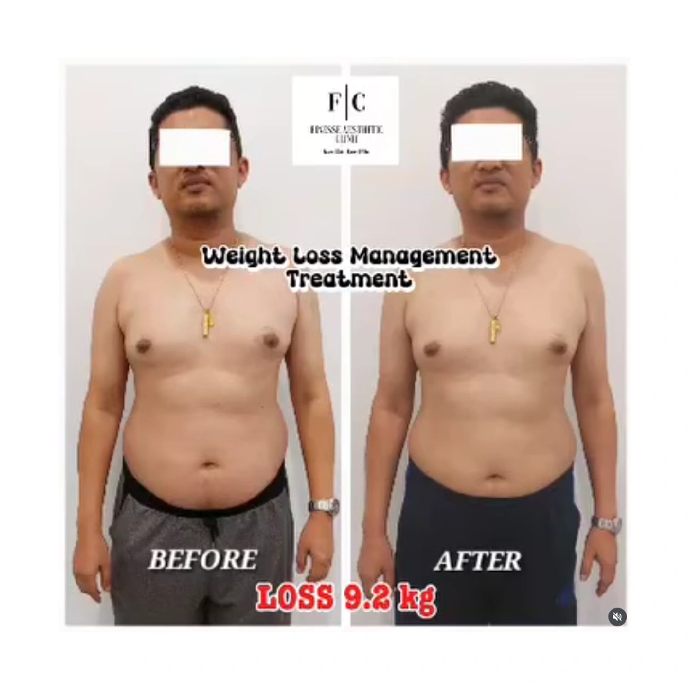 finesse mesolipo before after 5