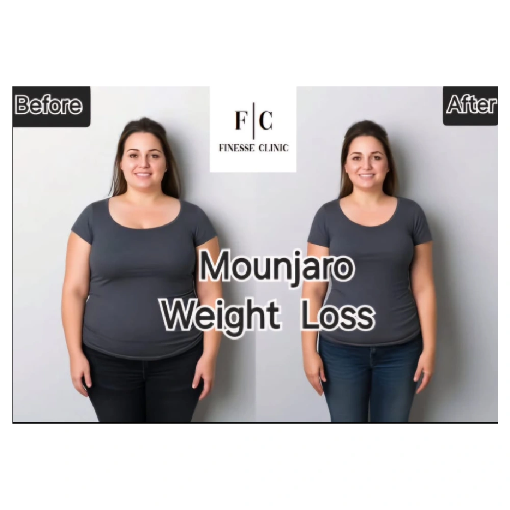 finesse mesolipo before after 6