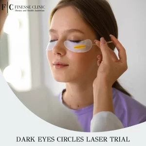 Dark eyes circles laser trial