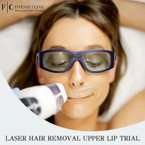 Laser hair removal upper lip trial
