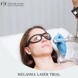 Melasma Laser Trial