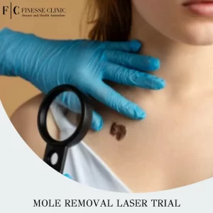 Mole removal laser trial