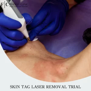 Skin tag laser removal trial
