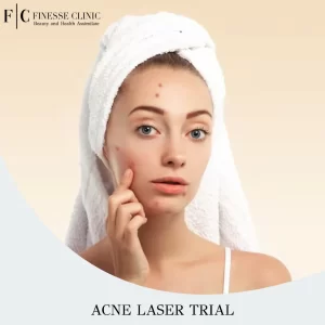 Acne Laser Trial