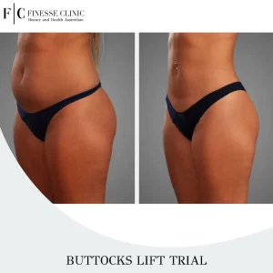 Buttocks Lift Trial