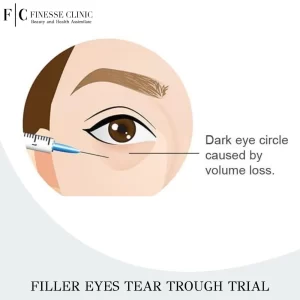 Filler Eyes Tear Trough Trial