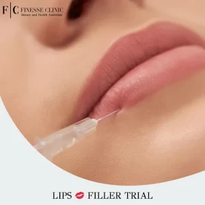Lips Filler Trial