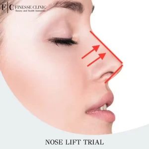 Nose Lift Trial