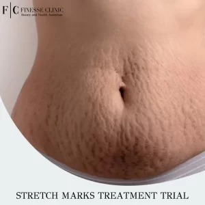 Stretch marks Treatment Trial