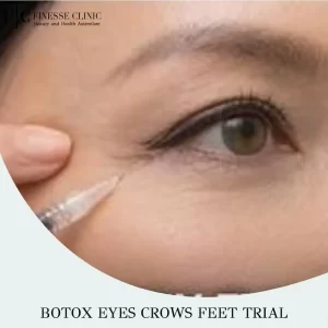 Botox Eyes Crows Feet Trial