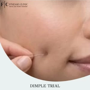 Dimple Trial