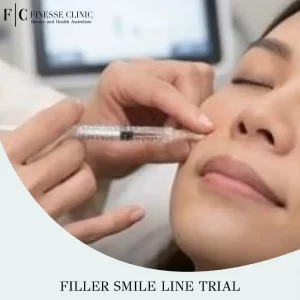 Filler Smile Line Trial