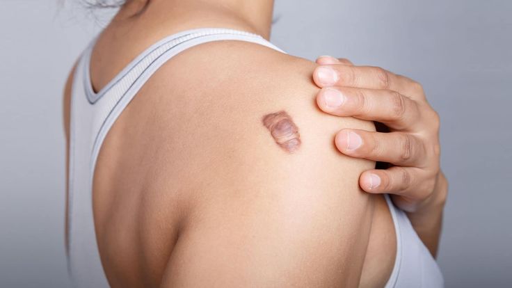 Keloid scars on behind the shoulder