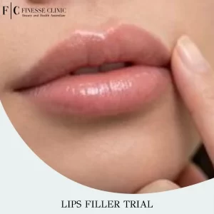 Lips Filler Trial
